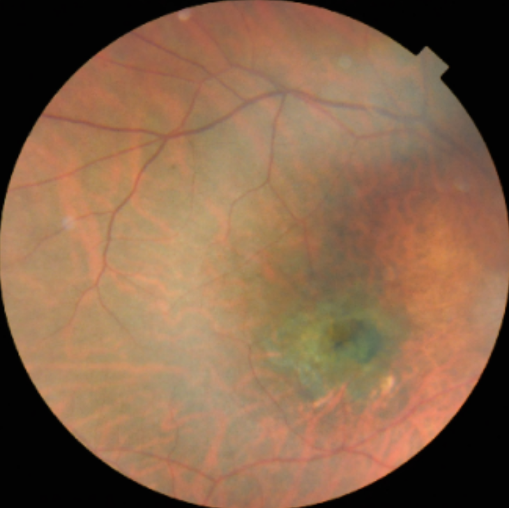 Preprocessed Retinal Scan